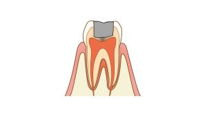 ドックベストセメント治療のイメージイラスト そよかぜ歯科